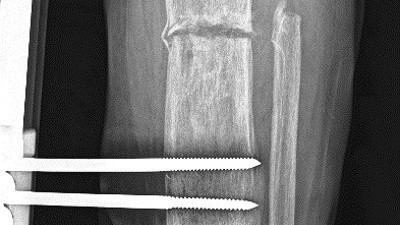 İş kazası geçiren hastanın mucize kurtuluşu