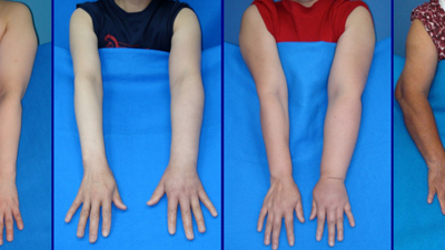 Meme kanseri ameliyatı sonrasında görülüyor. Uzmanı kadınları o hastalıkla ilgili uyardı