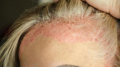 Saç dipleriniz böyle ise dikkat