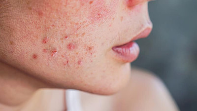 Bunları uygulayın cilt lekelerine elveda deyin. Cilt kremine yüzlerce lira vermenize gerek yok