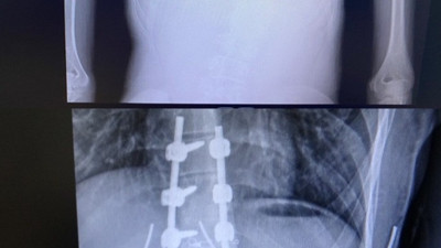 Doğuştan hasta genç kız ikinci ameliyatla sağlığına kavuştu. Mucize diye buna denir