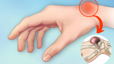 ''Ganglion kisti''hangi mesleklerde görülüyor