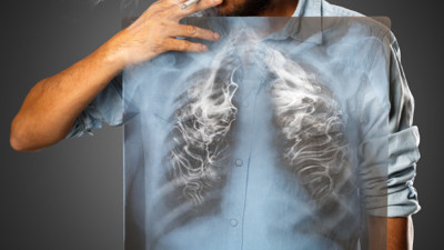 Sigara içenler için; Akciğer kanseri nedir? Belirtileri nelerdir?