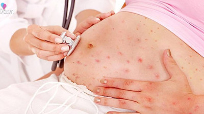 Anne adayları kızamık bebeğinizi öldürebilir