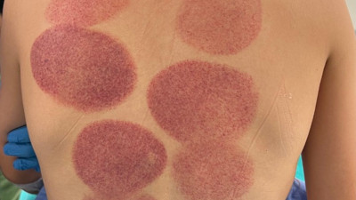 Söylenecek fazla bir şey yok. Apandisit tedavisi için son çare hastaneye başvurmuşlar