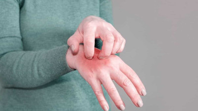 Uyuz hastalığı nedir? Afet bölgelerinde uyuz hastalığı neden olur?