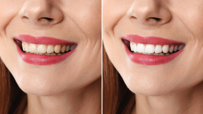 Diş Hekimi açıkladı. Dişlerin sararmaması için nelere dikkat etmeliyiz?