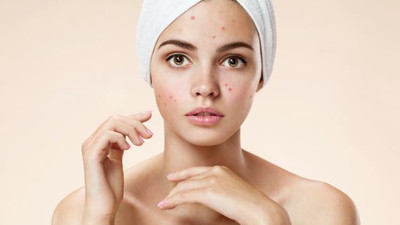 Görünüşüyle dikkat çekiyor. Akne ve sivilceleri yok ediyor