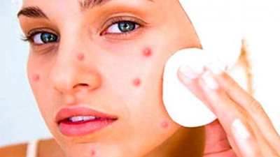 Hangi aknenin tedavisi yok