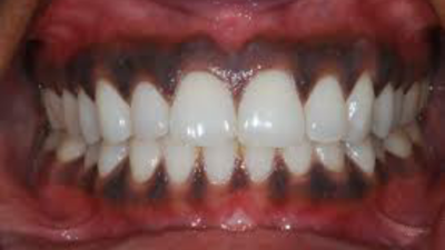 Diş eti rengi hangi hastalıkların habercisi