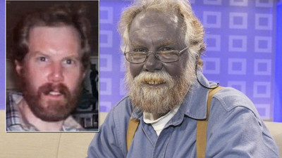 Mavi Adam ve Şirin Baba lakapları takıldı. Kocakarı ilacı yaptı rengi maviye döndü