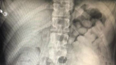 Hastanın röntgenine bakan doktor şok geçirdi
