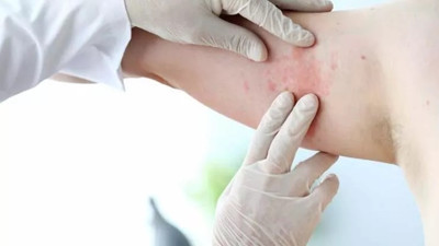 Zona belirtileri nelerdir?