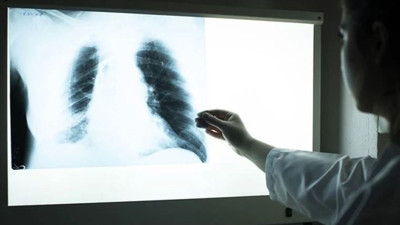 Koronadan sonra en fazla ölüme neden olan hastalık belli oldu