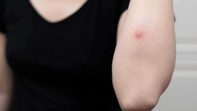 Çıbana iyi gelen bitki