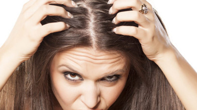 Saçkıran tedavi yöntemleri nelerdir?