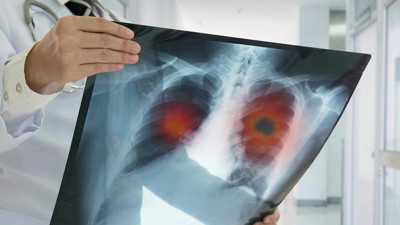 KOAH tedavi yöntemleri nelerdir?