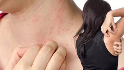 Kurdeşene iyi gelen ot