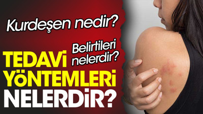Kurdeşen nedir? Kurdeşen belirtileri nelerdir? Kurdeşen tedavi yöntemleri nelerdir?