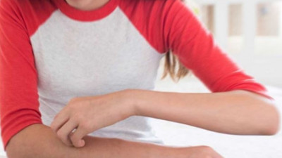 Kurdeşen belirtileri nelerdir?