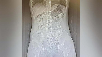 2 kadının midelerinden çıkanlar şoke etti! Tamı tamına 693 adet...