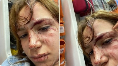 Sokak köpeği terörü üniversitede. Öğrenci kanlar içinde kaldı