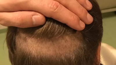 Uzmanı açıkladı: Saç ekiminin mevsimi olmaz