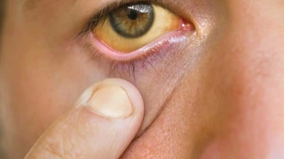 Sarılığı bitiren üç bitkisel kür tarifi