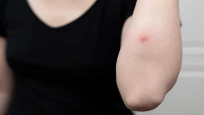 Vücuttaki yaraları hızlıca tedavi eden 7 doğal yöntem