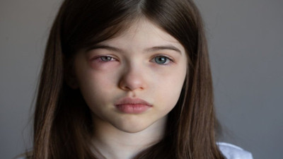 Uzmanı açıkladı. Bahar aylarında göz alerjilerine dikkat