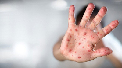 DSÖ açıkladı. Maymun çiçeği tehlikesi bitti