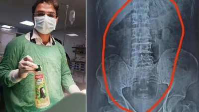 Tıp dünyası şokta. Mide ağrısıyla hastaneye gitti. Midesinden pet şişe çıktı