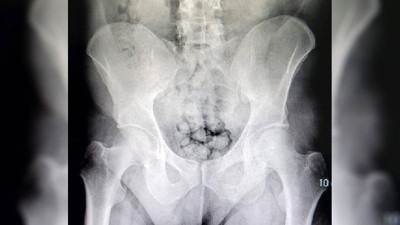 Metamfetamin kapsüllerini midelerine sakladılar polis tarafından kıskıvrak yakalandılar