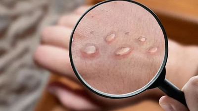 Pekin’de maymun çiçeği virüsü nedeniyle 2 kişi karantinaya alındı