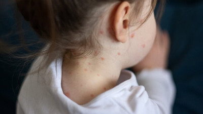 Kızamık nedir? Kızamık vakaları neden artıyor?