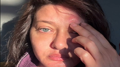 Nurgül Yeşilçay yaşadığı sivrisinek mağduriyetini paylaştı