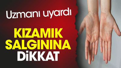 Kızamık salgınına dikkat. Uzmanı uyardı