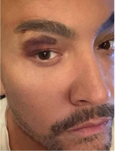 Ünlü şarkıcı Cenk Eren sahnede kaza geçirdi! Gözündeki morluk endişelendirdi - Resim : 1