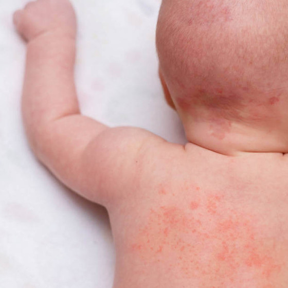 Görünmez tehdidin ciltteki izleri! Çocuklarda döküntü alarmı