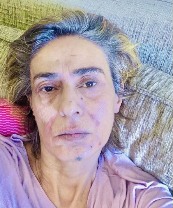 Yıldız Tilbe'yi örümcek ısırdı! Aksilikler kraliçesi... Yüzü korkuttu - Resim: 1