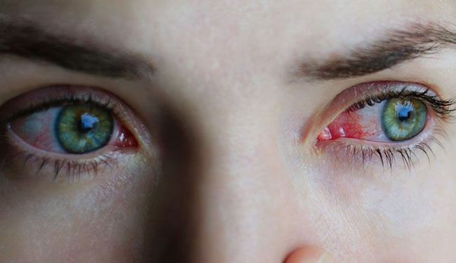 Gözlerin gizli düşmanı ortaya çıktı! Uzmanlar anlattı - Resim: 8