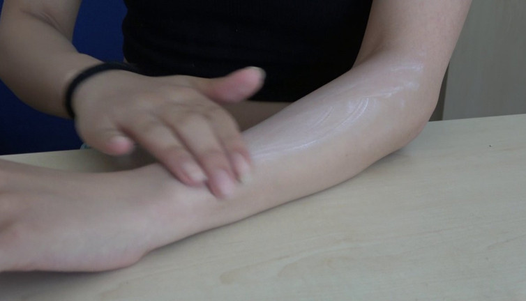 Güneş yanıklarına sakın böyle müdahale etmeyin. Uzmanı uyardı