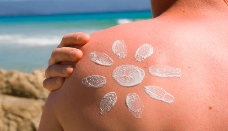 Güneş yanığı belirtileri neler? Güneş yanığına ne iyi gelir?