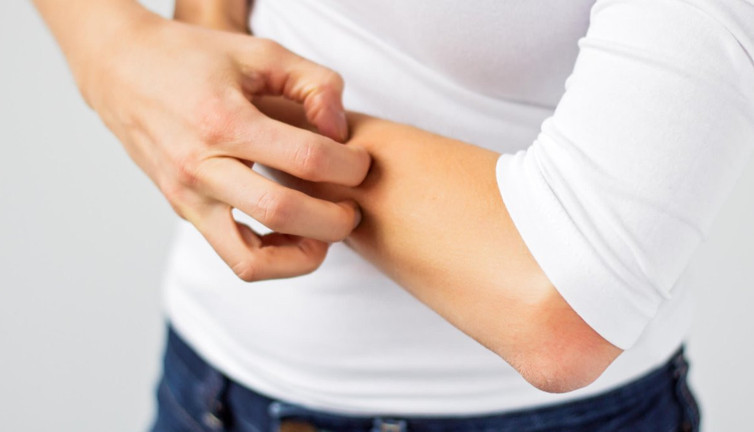 Egzama hastalığına iyi gelen mucize bitki