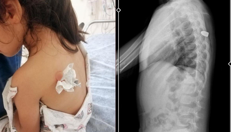 6 yaşındaki Meliha sırtını ‘böcek ısırdı’ sanıyor ama maganda kurşunu bu kez ona isabet etti