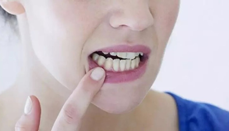 Ağız yaralarını 1 saat içinde yok eden tarif ortaya çıktı. 1 yemek kaşığı yetiyor