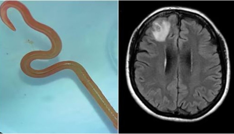 Unutkanlık ve depresyon şikayetiyle hastaneye gitti. Beyninden solucan çıktı