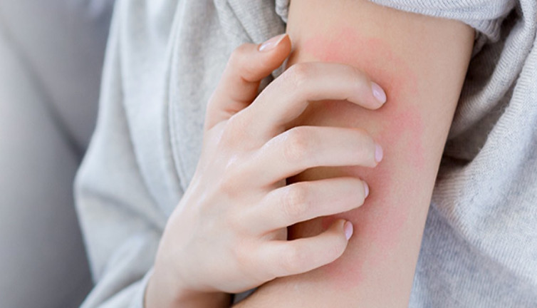 Uyuz hastalığı nasıl bulaşır? Uyuz belirtileri neler?