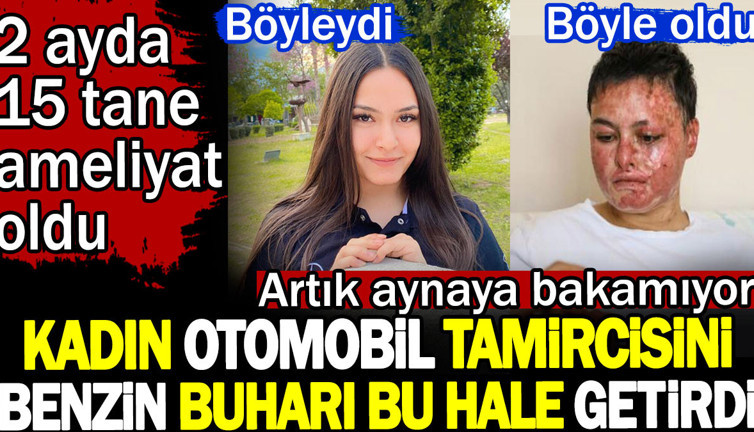 Kadın otomobil tamircisini benzin buharı bu hale getirdi. Artık aynaya bakamıyor. 2 ayda 15 tane ameliyat oldu