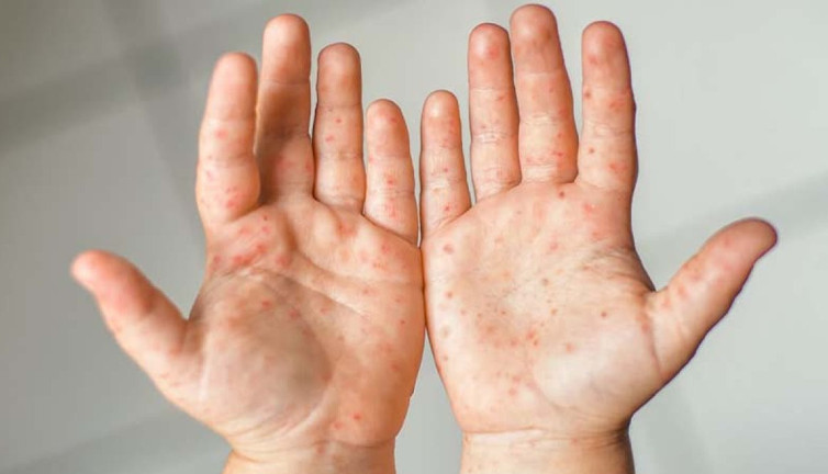 Avuç içi döküntüler neyin habercisi